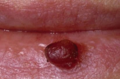 pinnacleskin.com /conditions/granuloma Carousel 1 Image 1