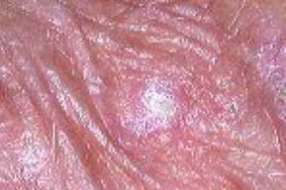 actinic-keratosis-example