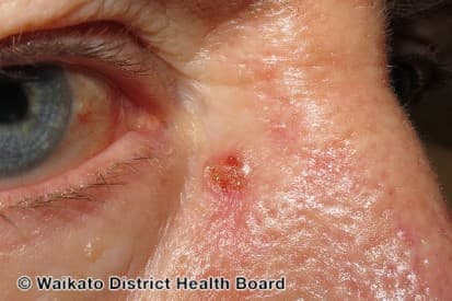 pinnacleskin.com /conditions/basal-cell-carcinoma Carousel 1 Image 6