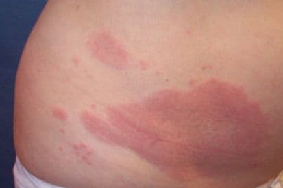 pinnacleskin.com /conditions/granuloma Carousel 1 Image 4